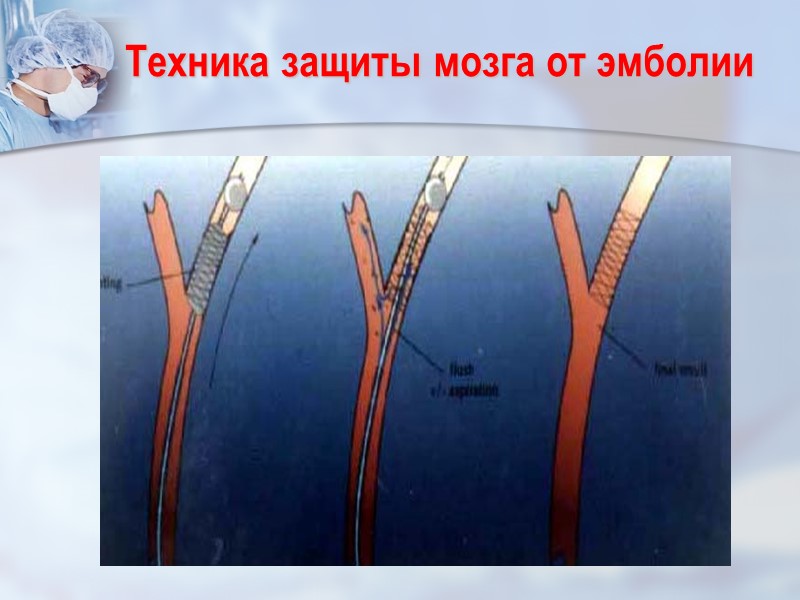 Техника защиты мозга от эмболии